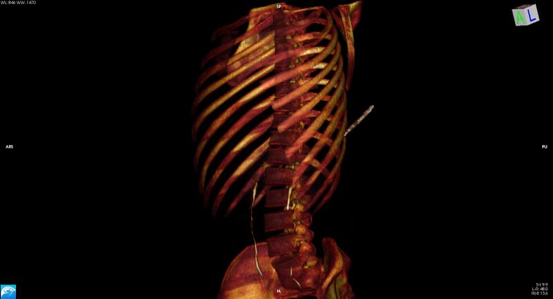 File:Arrow injury to the chest (Radiopaedia 75223-86321 3D bone 8).jpg