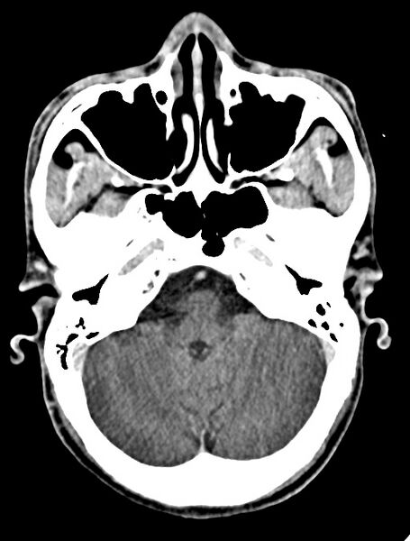 File:Arrow injury to the face (Radiopaedia 73267-84011 Axial C+ delayed 39).jpg