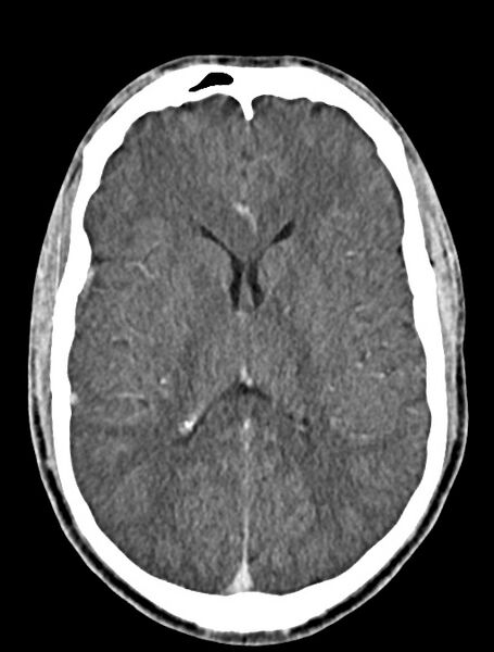 File:Arrow injury to the face (Radiopaedia 73267-84011 Axial C+ delayed 56).jpg