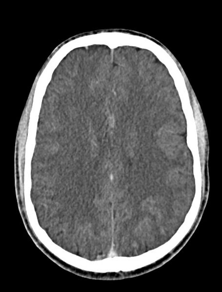 File:Arrow injury to the face (Radiopaedia 73267-84011 Axial C+ delayed 61).jpg