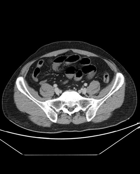 File:Arterial occlusive mesenteric ischemia (Radiopaedia 84641-100054 A 90).jpg