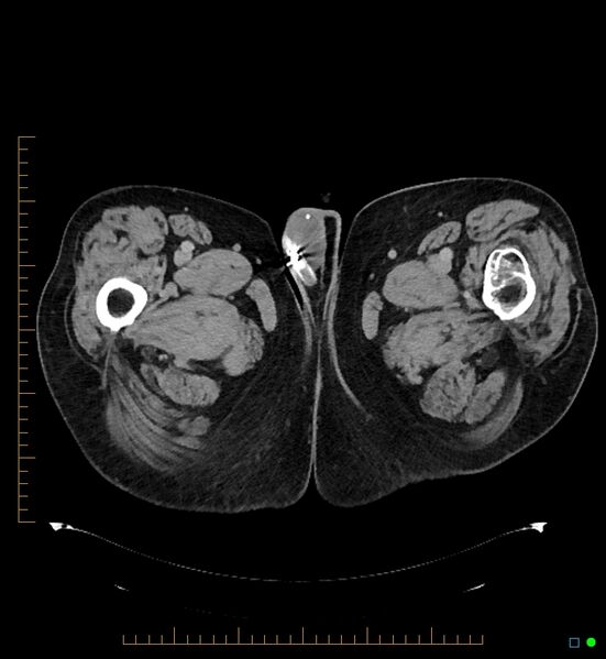 File:Artificial urethral sphincter (Radiopaedia 46937-51464 A 21).jpg