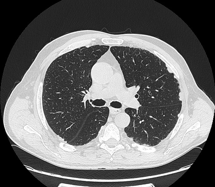 File:Asbestos pleural placques (Radiopaedia 57905-64872 Axial lung window 106).jpg