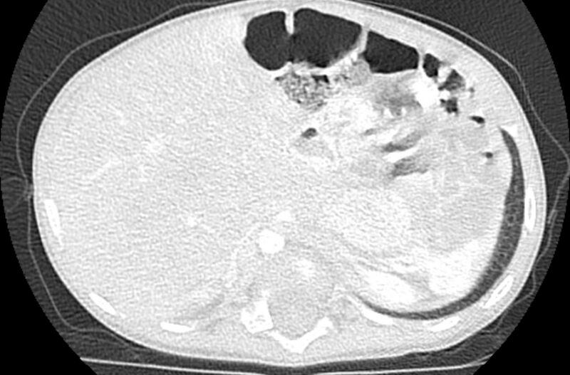 File:Asplenia syndrome (Radiopaedia 73083-83792 Axial lung window 75).jpg