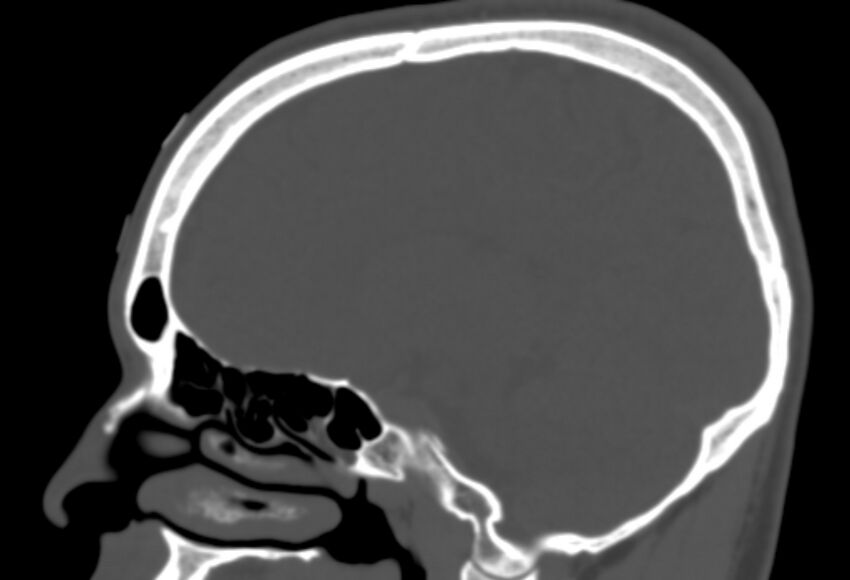 Asymptomatic occipital spur (Radiopaedia 87753-104201 Sagittal bone window 130).jpg