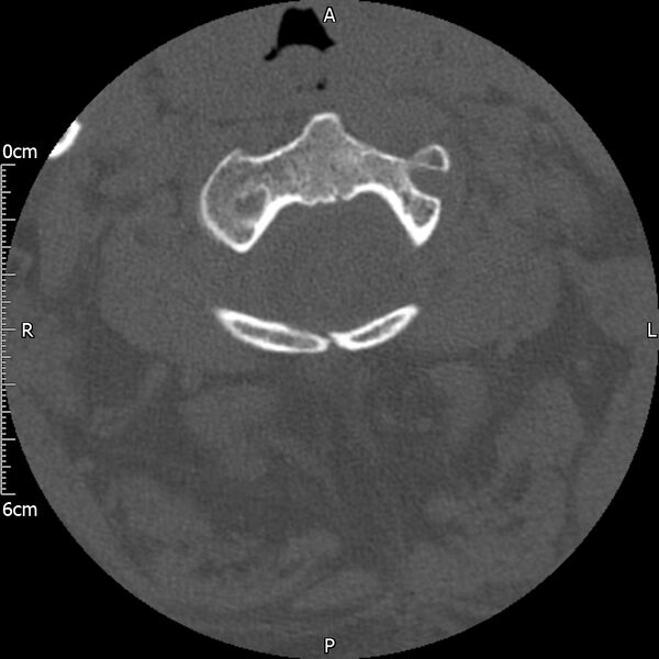 File:Atlas fracture with Currarino type A congenital defect (Radiopaedia 71747-82144 Axial bone window 54).jpg