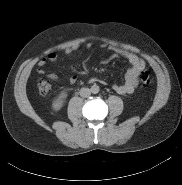 File:Atrophic kidney due to severe chronic obstructive hydronephrosis (Radiopaedia 40828-43474 Axial non-contrast 15).jpg