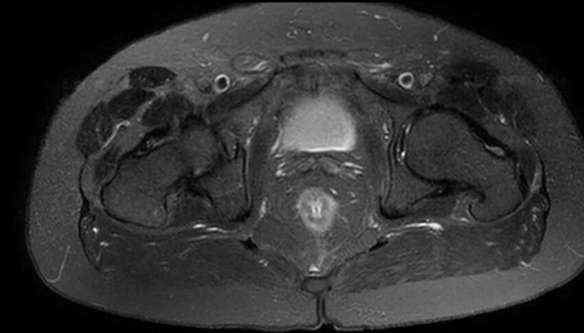 Atypical lipomatous tumor - thigh (Radiopaedia 68975-78734 Axial T2 fat sat 90).jpg