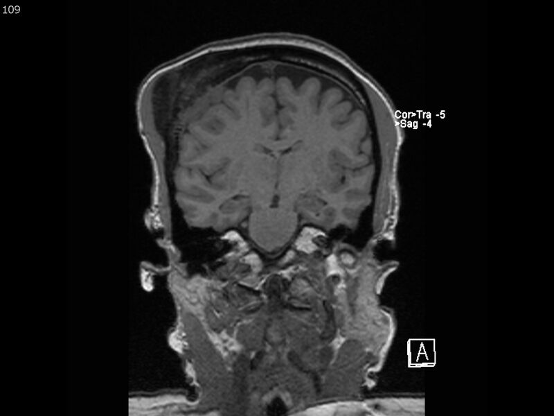 File:Atypical meningioma - intraosseous (Radiopaedia 64915-74572 Coronal T1 109).jpg