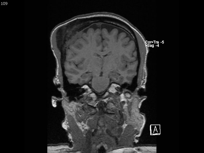 Atypical meningioma - intraosseous (Radiopaedia 64915-74572 Coronal T1 109).jpg