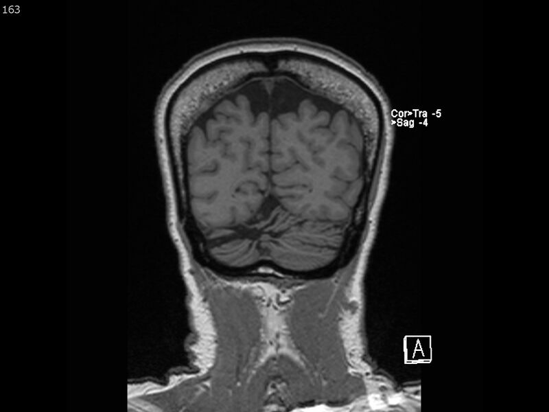 File:Atypical meningioma - intraosseous (Radiopaedia 64915-74572 Coronal T1 163).jpg