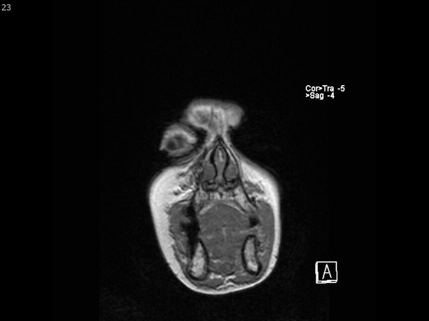 Atypical meningioma - intraosseous (Radiopaedia 64915-74572 Coronal T1 23).jpg