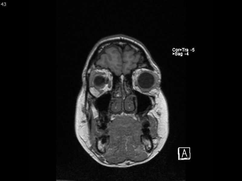 File:Atypical meningioma - intraosseous (Radiopaedia 64915-74572 Coronal T1 43).jpg