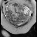 Atypical retroperitoneal lymphocoeles with large leiomyoma of uterus (Radiopaedia 32084-33027 Coronal T2 6).jpg