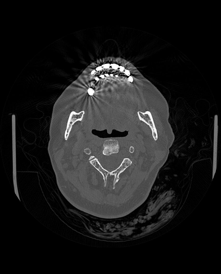 Automastoidectomy with labyrinthine fistula (Radiopaedia 84143-99411 Axial non-contrast 3).jpg
