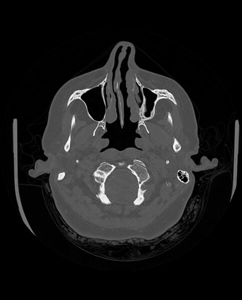 File:Automastoidectomy with labyrinthine fistula (Radiopaedia 84143-99411 Axial non-contrast 54).jpg