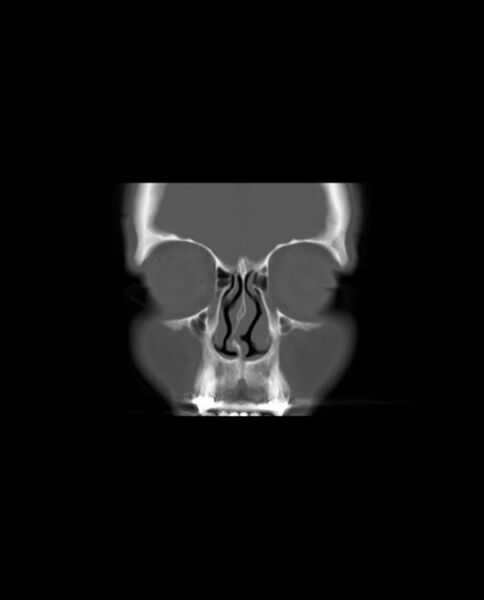 File:Automastoidectomy with labyrinthine fistula (Radiopaedia 84143-99411 Coronal non-contrast 12).jpg