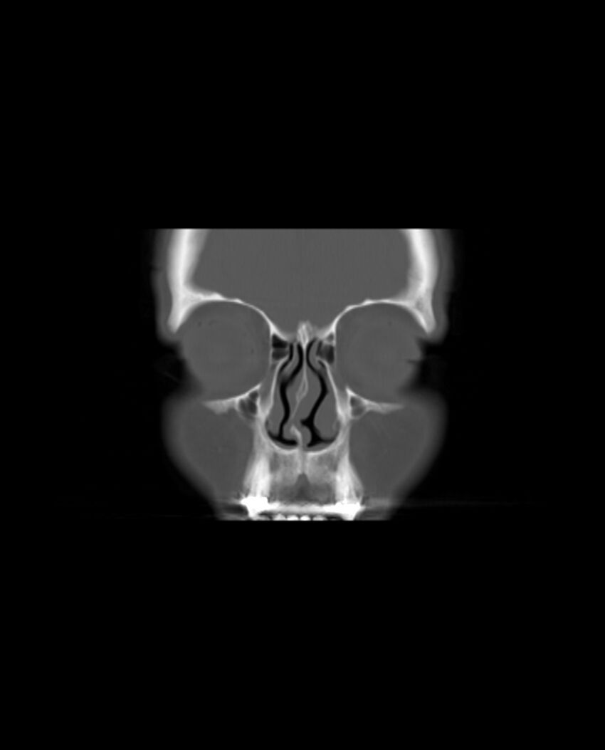 Automastoidectomy with labyrinthine fistula (Radiopaedia 84143-99411 Coronal non-contrast 12).jpg