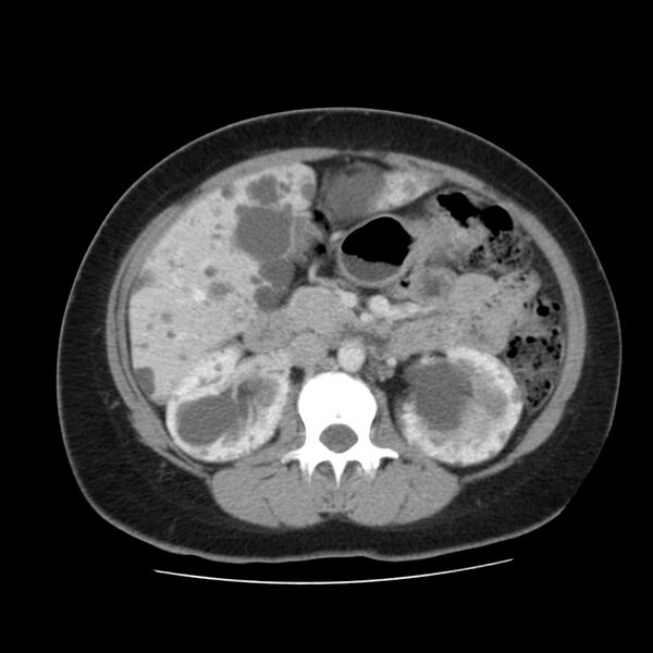 File:Autosomal dominant polycystic kidney disease (Radiopaedia 23061-23093 C 27).jpg