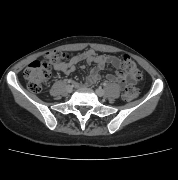 File:Autosomal dominant polycystic kidney disease - early onset (Radiopaedia 40734-43387 A 60).jpg