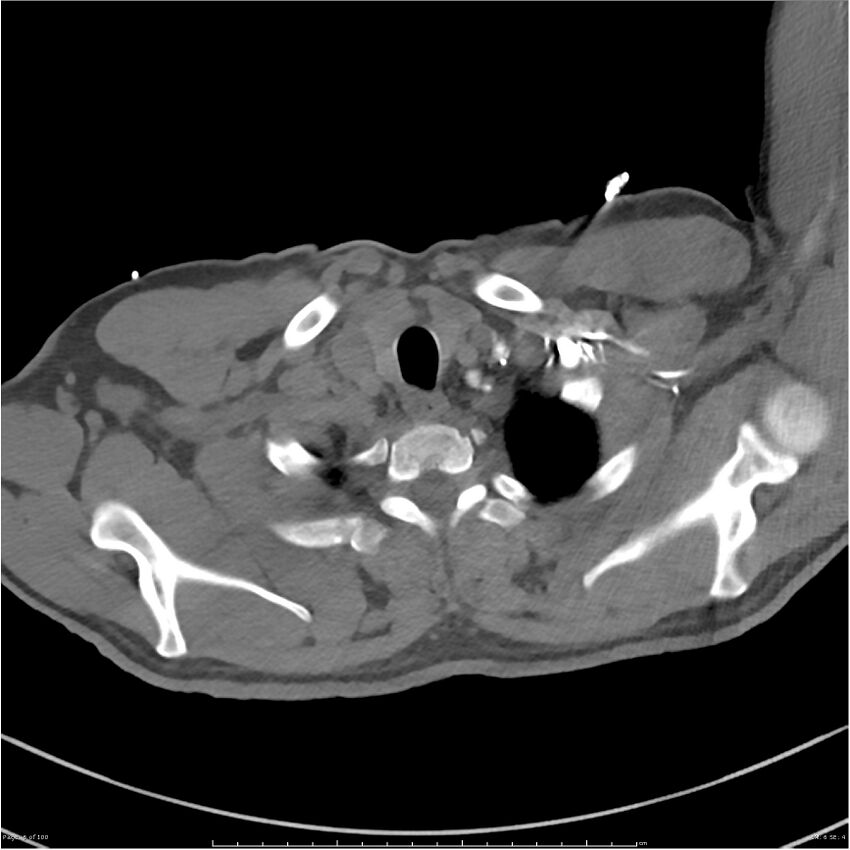 Azygos venous system anatomy (CT pulmonary angiography) (Radiopaedia 25928-26077 Axial C+ CTPA 6).jpg