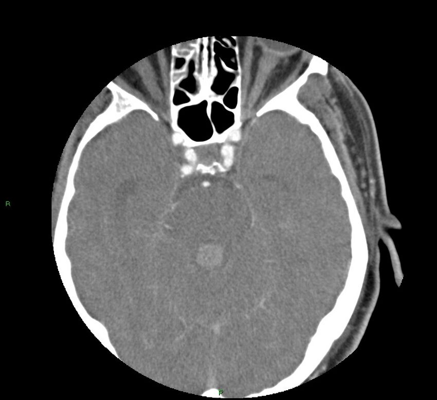 Basal ganglia hemorrhage (Radiopaedia 58763-65985 D 67).jpg