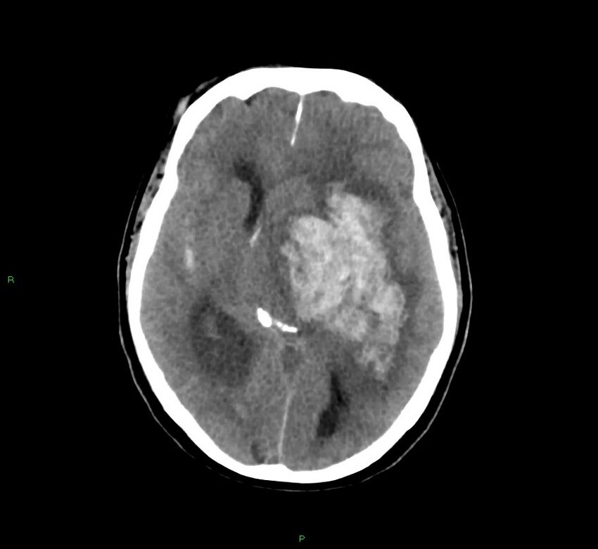Basal ganglia hemorrhage (Radiopaedia 58775-66008 Axial non-contrast 34).jpg