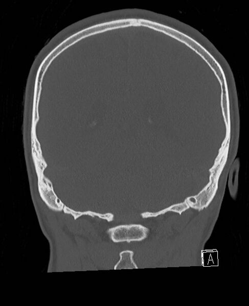 File:Base of skull fracture with bilateral Le Fort fractures (Radiopaedia 47094-51638 Coronal bone window 29).jpg