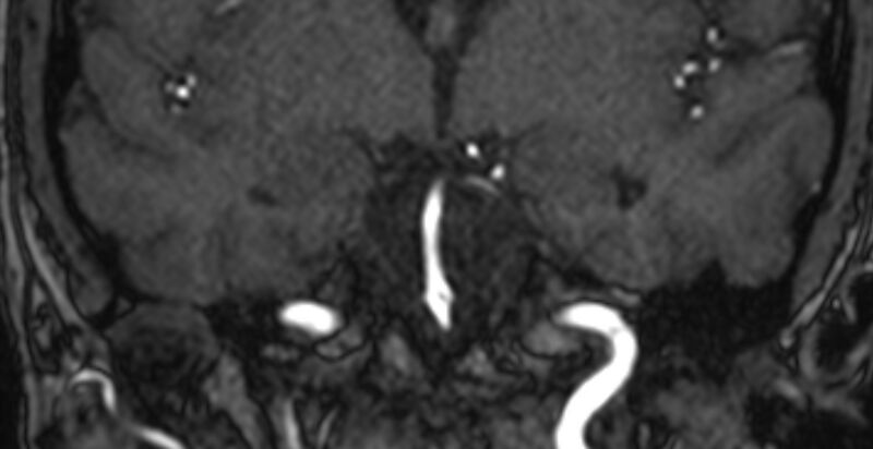 File:Basilar artery fenestration (Radiopaedia 74537-85455 Coronal MRA TOF 37).jpg