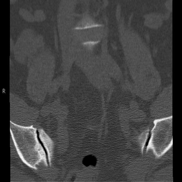 File:Bertolotti syndrome (Radiopaedia 24864-25128 Coronal bone window 7).jpg
