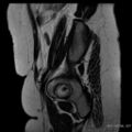Bicornuate uterus- on MRI (Radiopaedia 49206-54297 Sagittal T2 26).jpg