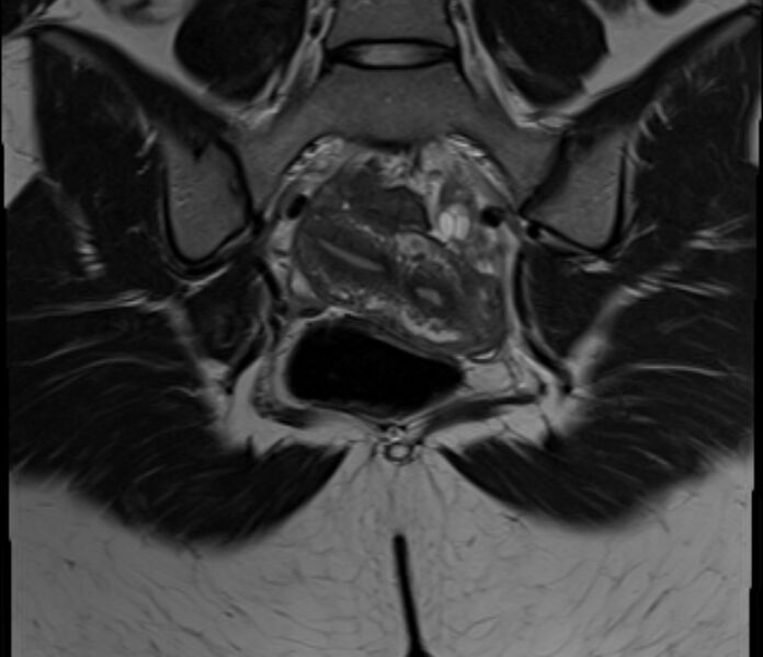 File:Bicornuate uterus (Radiopaedia 71214-81511 Coronal T2 8).jpg