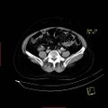 Bifid ureter (Radiopaedia 47604-52253 Axial C+ delayed 17).jpg