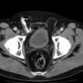 Bilateral direct inguinal herniae (Radiopaedia 17016-16719 B 17).jpg