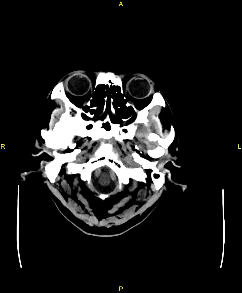 Bilateral isodense subdural hematomas (Radiopaedia 88621-105325 Axial non-contrast 8).jpg