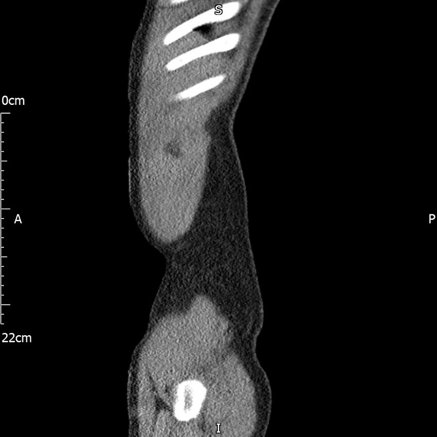 Bilateral medullary nephrocalcinosis with ureteric calculi (Radiopaedia 71269-81569 C 107).jpg