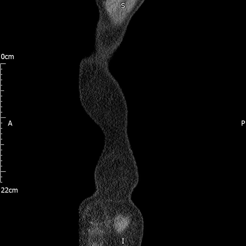 Bilateral medullary nephrocalcinosis with ureteric calculi (Radiopaedia 71269-81569 C 112).jpg