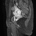 Bilateral ovarian endometriomas (Radiopaedia 87085-103347 F 18).jpg