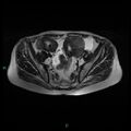 Bilateral ovarian fibroma (Radiopaedia 44568-48293 Axial T2 10).jpg
