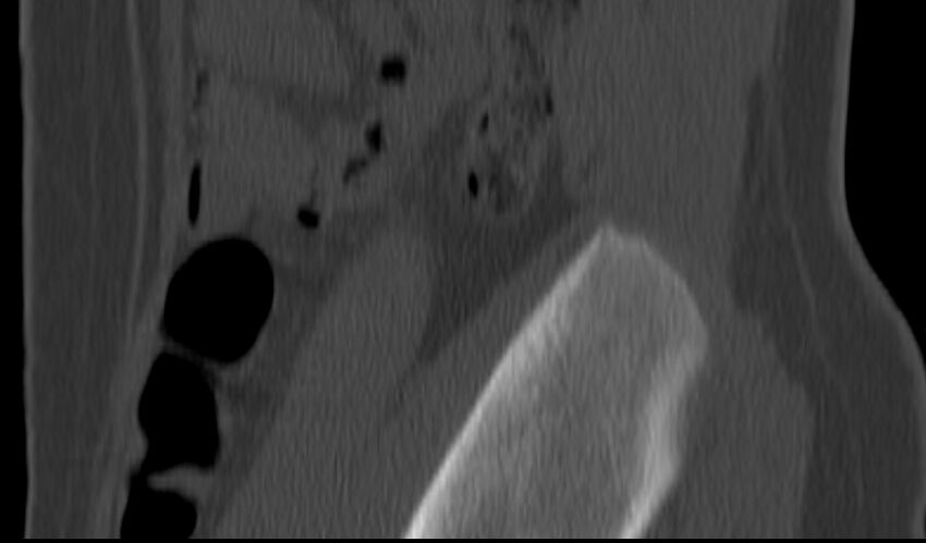 Bilateral pars defect (Radiopaedia 26691-26846 Sagittal bone window 62).jpg