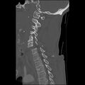Bilateral perched facets with cord injury (Radiopaedia 45587-49713 Sagittal bone window 32).jpg