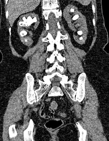 File:Bilateral staghorn calculi (Radiopaedia 59475-66842 Coronal non-contrast 76).jpg