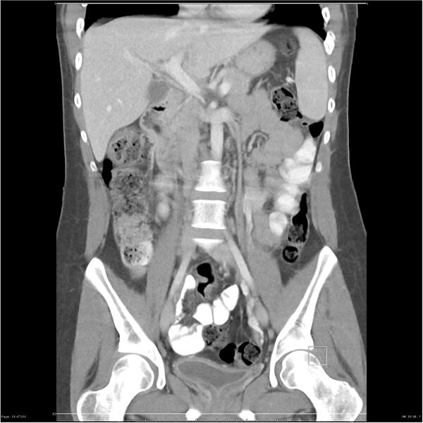File:Bilateral ureteritis and cystitis (Radiopaedia 25340-25594 B 19).jpg