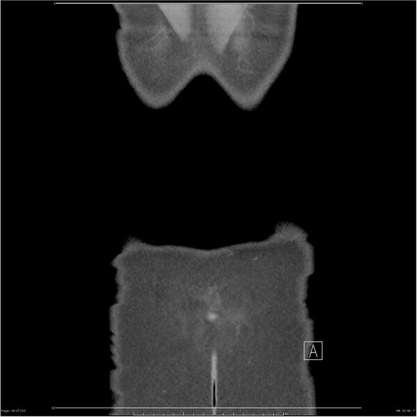 File:Bilateral ureteritis and cystitis (Radiopaedia 25340-25594 B 40).jpg