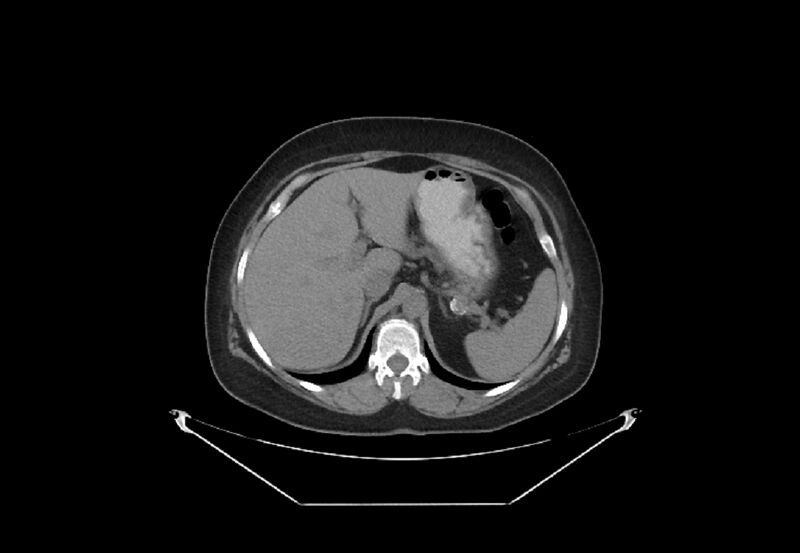 File:Bilateral urolithiasis with incidentally detected splenic artery aneurysm and left inferior vena cava (Radiopaedia 44467-48123 Axial non-contrast 9).jpg