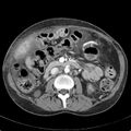 Biliary necrosis - liver transplant (Radiopaedia 21876-21846 B 35).jpg