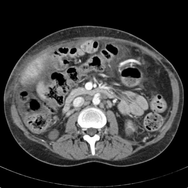 File:Biliary necrosis - liver transplant (Radiopaedia 21876-21846 B 35).jpg
