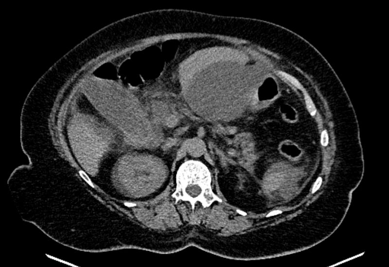 File:Biliary pancreatitis (Radiopaedia 72289-82823 Axial non-contrast 95).jpg