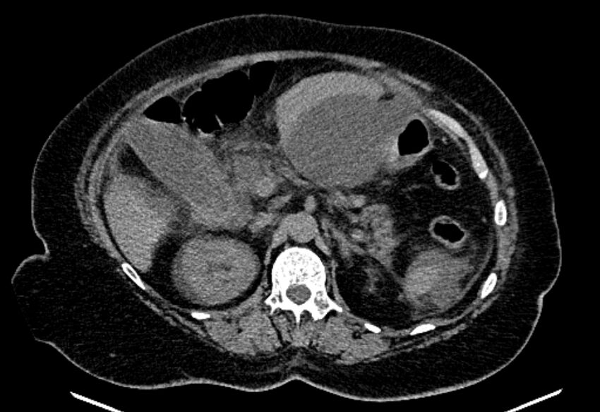 Biliary pancreatitis (Radiopaedia 72289-82823 Axial non-contrast 95).jpg