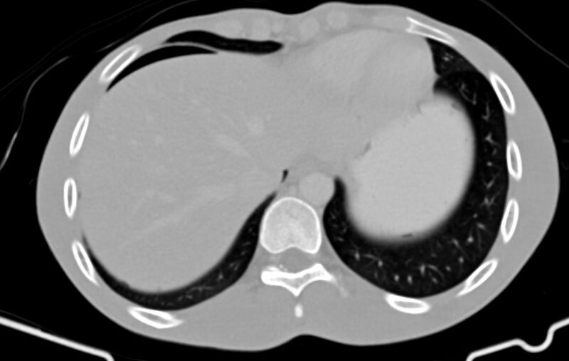 File:Blunt injury to the small bowel (Radiopaedia 74953-85987 Axial Wide 2).jpg